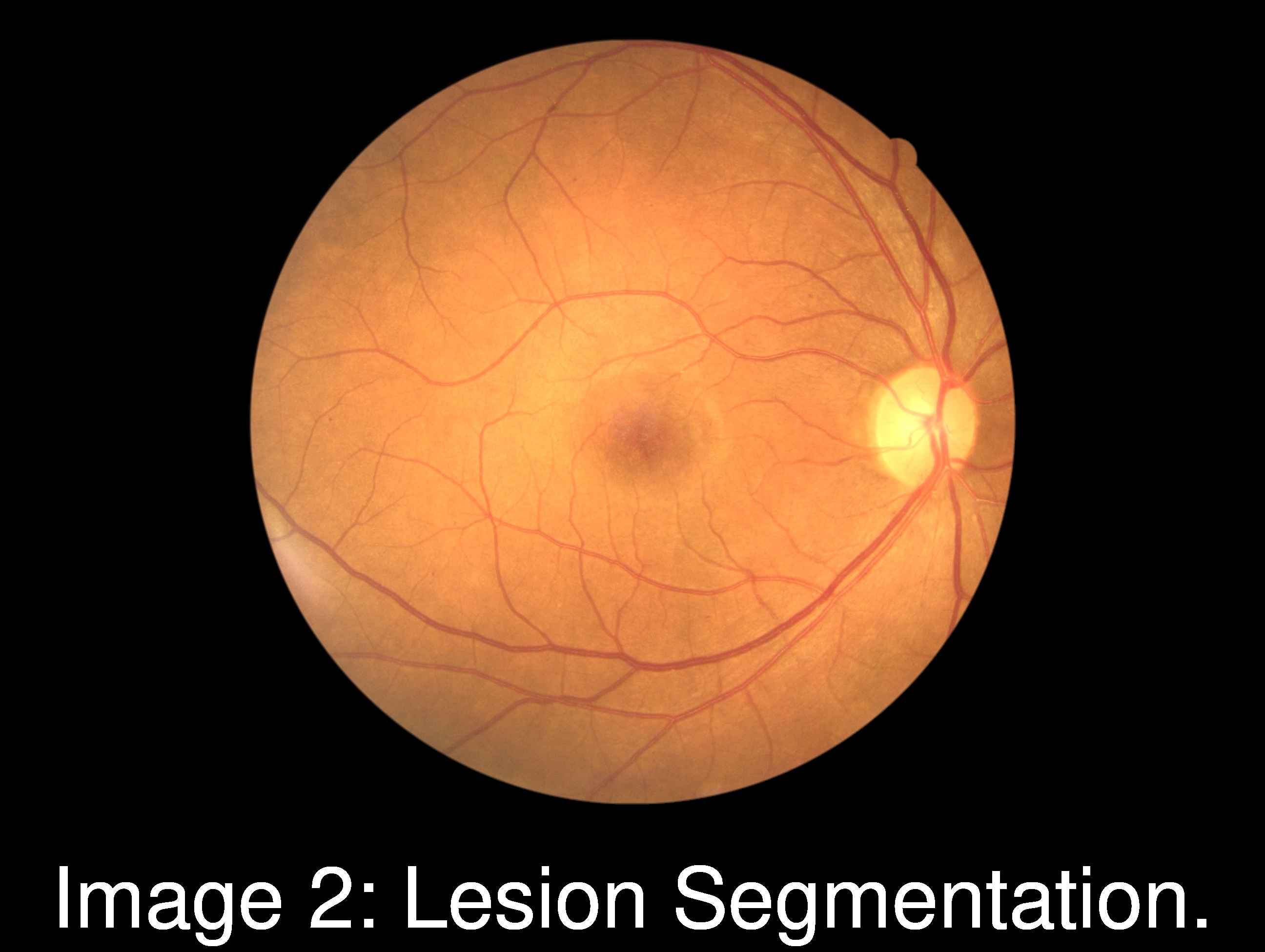 lesion_segmentation_sample.jpg